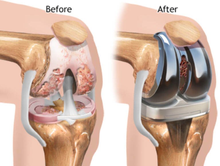 Knee replacement Perth for injured knees.