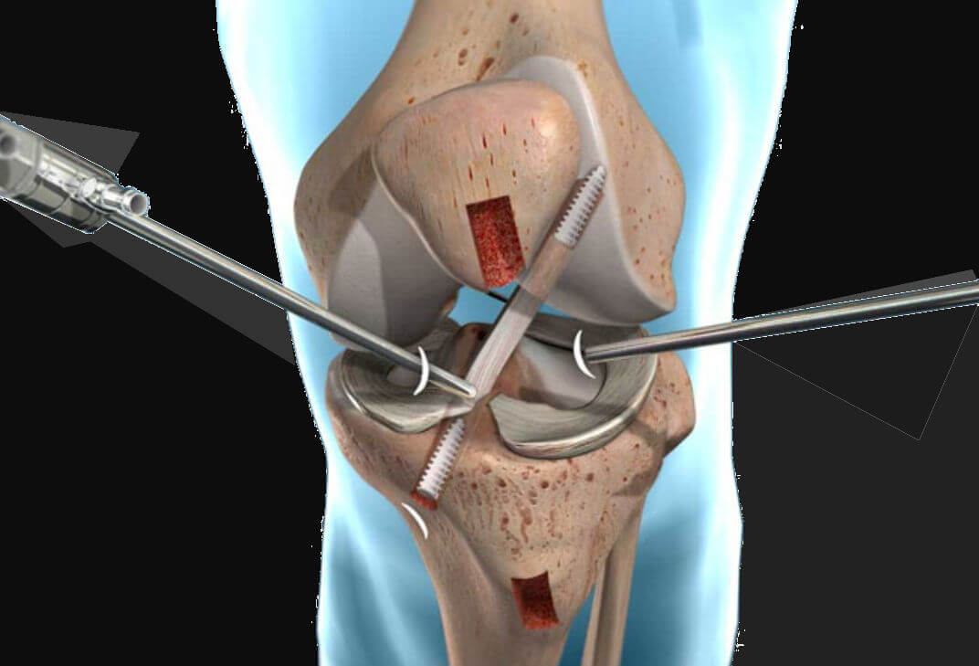 ACL sergery Perth by expert ACL sergeon in Perth.