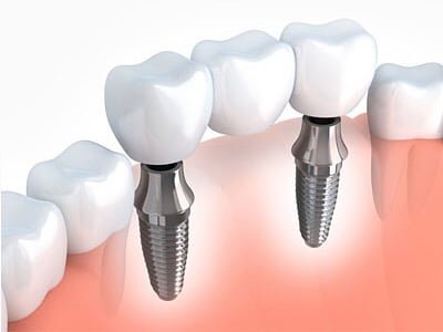 Dental implants Brisbane.